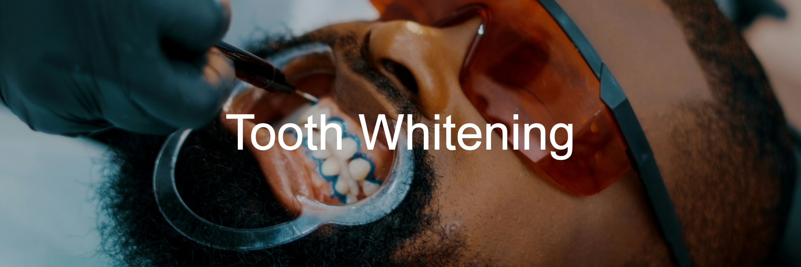 Tooth-Whitening-Slider-Image2