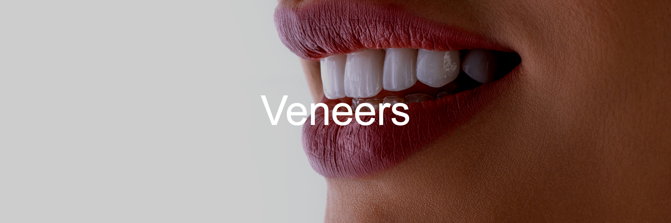Veneers-Slider-Image2